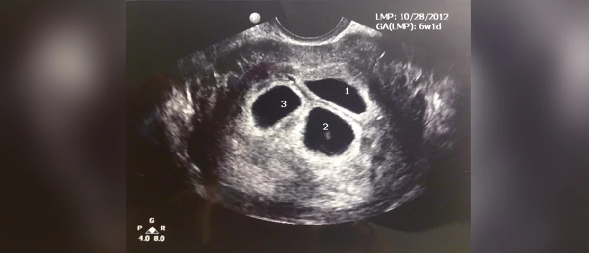 fetal-reduksion